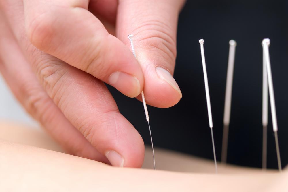 - Harnessing the Potential of Acupuncture for Holistic Wellness